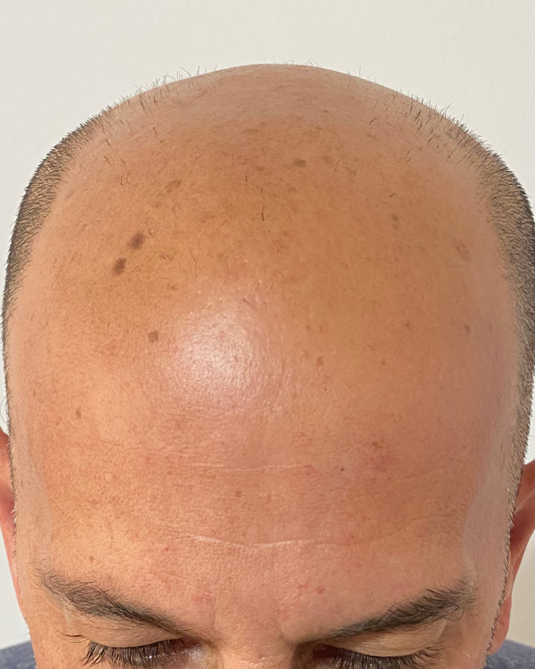 Antes — Línea Frontal